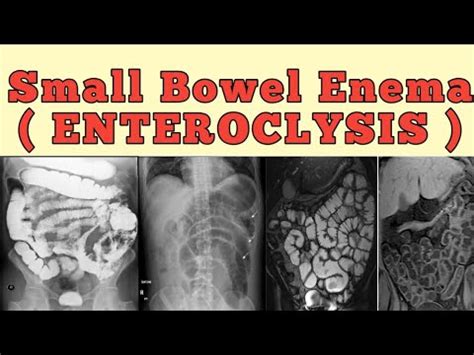 enema asian|[PDF] Small bowel enema use in an Asian population: our eleven .